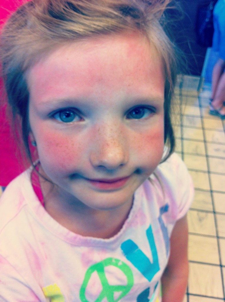 sunburned